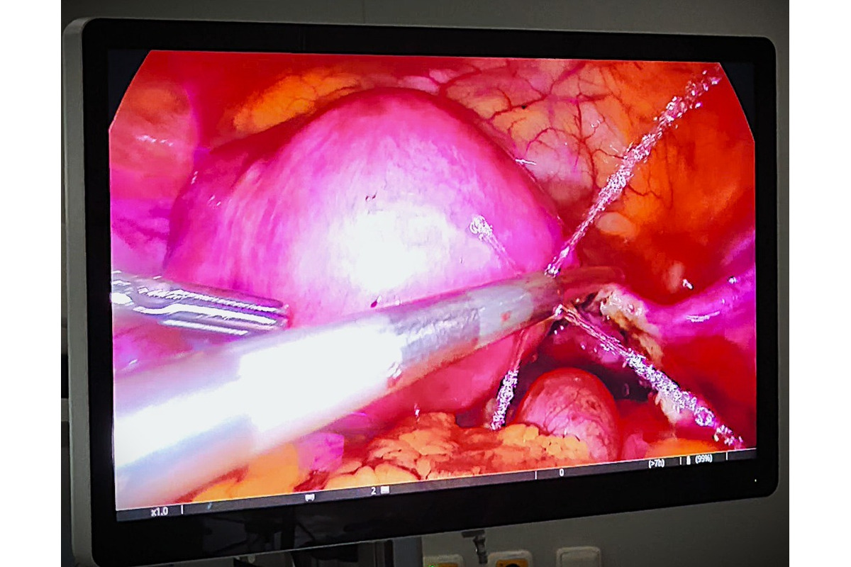 FOTO: Gynekologické oddelenie v Bojniciach má nové špičkové vybavenie. Ponúka 4K technológiu a rýchlejšie zákroky, foto 5