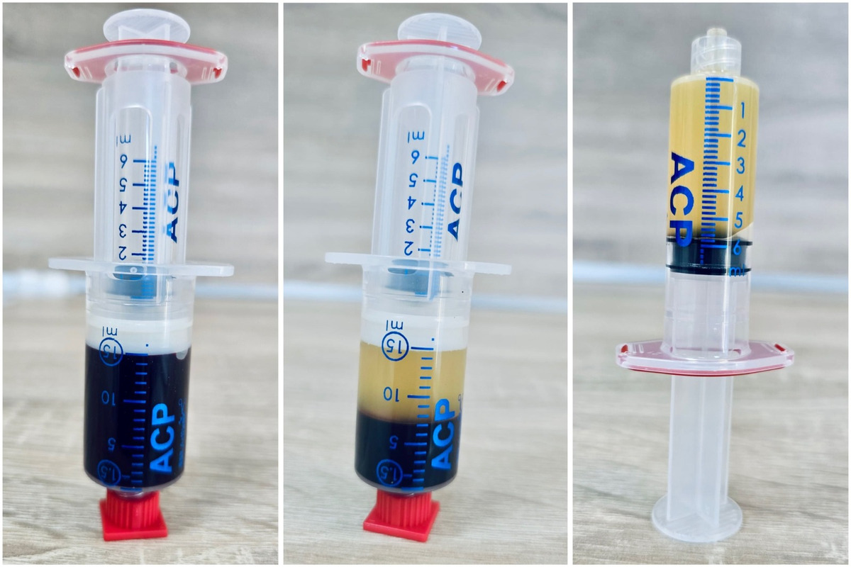 FOTO: Bánovská nemocnica prináša prelomovú terapiu. Liečba krvou pacienta urýchľuje hojenie, foto 2