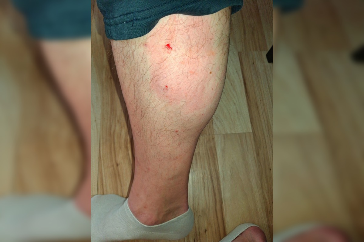 FOTO: V Dubnici nad Váhom pohrýzol pes v parku svojho majiteľa kvôli nezodpovednej psíčkarke, foto 1