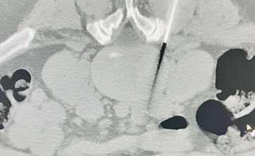 FOTO: CT pracovisko bánovskej nemocnice začalo s poskytovaním ozónoterapie