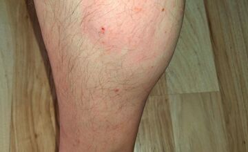 FOTO: V Dubnici nad Váhom pohrýzol pes v parku svojho majiteľa kvôli nezodpovednej psíčkarke