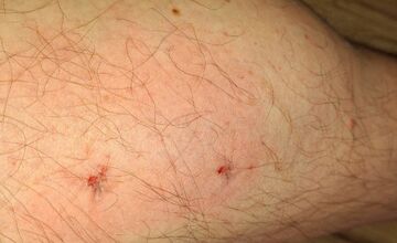 FOTO: V Dubnici nad Váhom pohrýzol pes v parku svojho majiteľa kvôli nezodpovednej psíčkarke